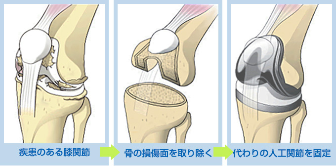 変形性膝関節症と治療方法 当院の膝 股関節の治療 医療法人社団 弘人会中田病院