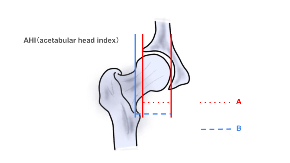 大腿骨臼蓋インピンジメント症候群（FAI：femoroacetabular