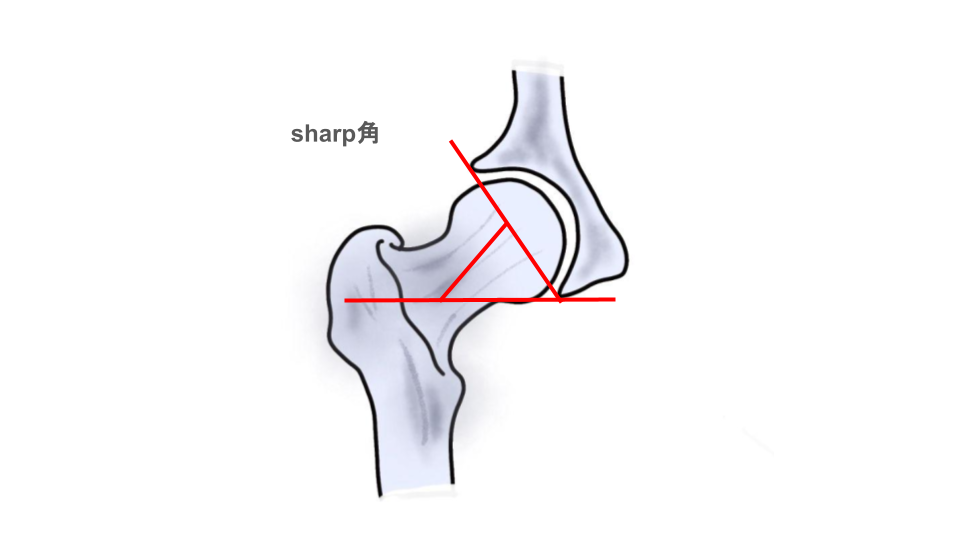 大腿骨近位部骨折 Osteosynthesis & Arthroplasty Osteosynthesis and outcomes of traumatic periprosthetic