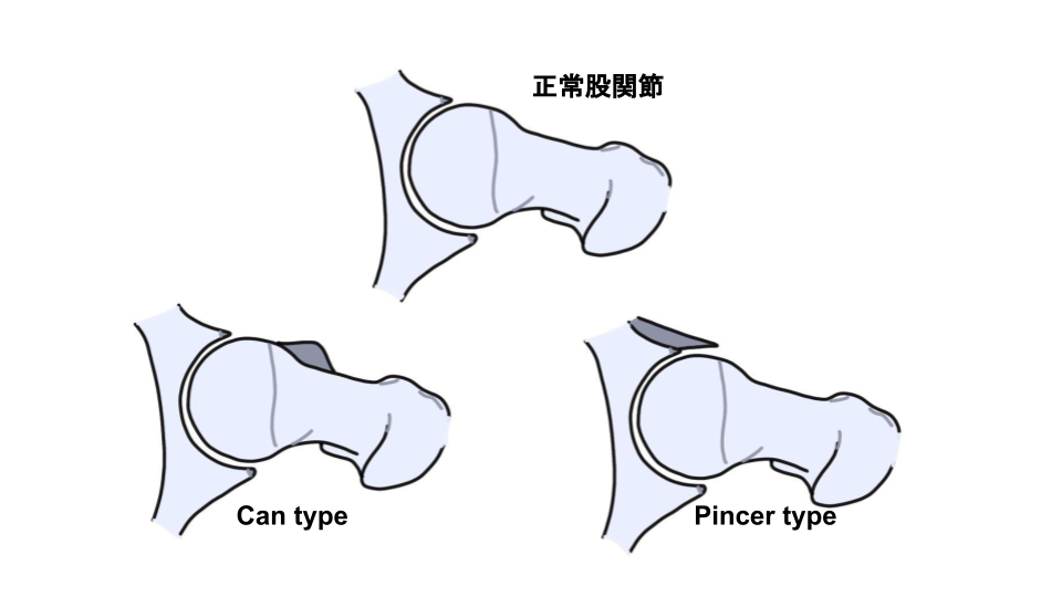 整形外科医がスキーでの大腿骨頚部骨折の手術後434日目のブログ