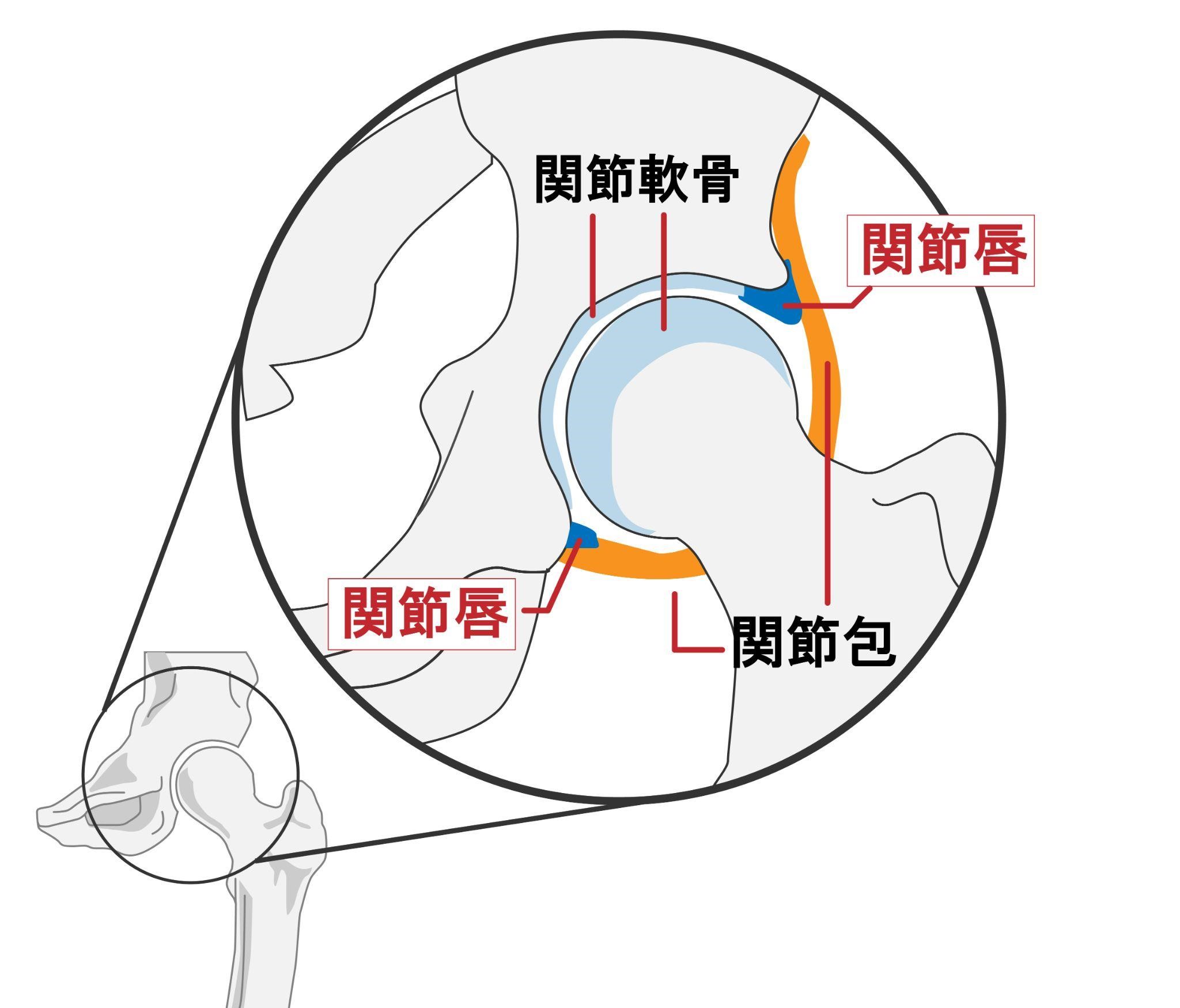 大腿骨臼蓋インピンジメント症候群（FAI：femoroacetabular